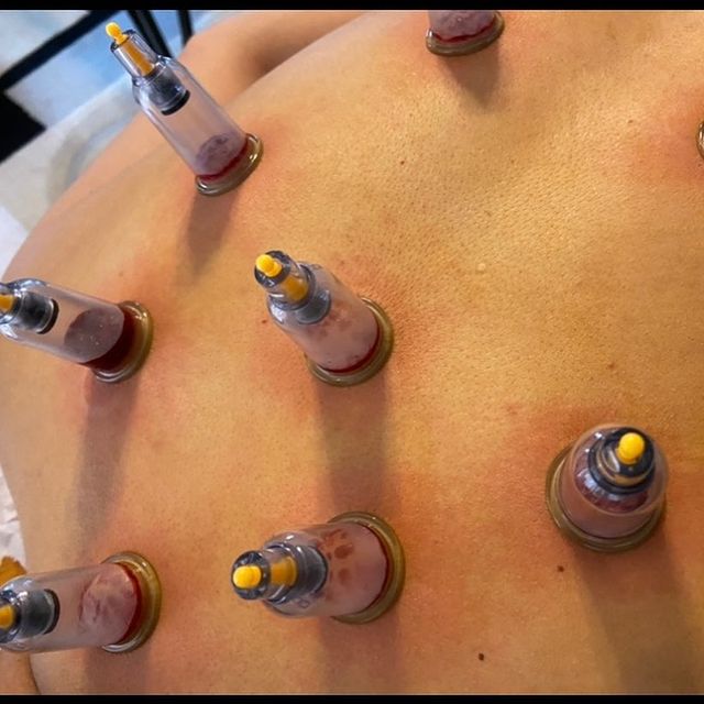 Cupping - Consultation